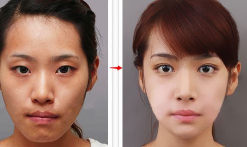韩式双眼皮手术后的恢复时间