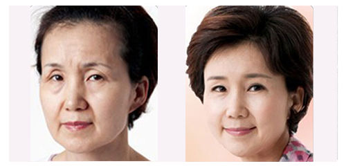 韩式祛眼袋手术的价格,韩式祛眼袋手术的价格是多少,韩式无痕去眼袋