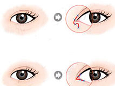 开眼角的疤痕多久可以恢复,开眼角疤痕消失时间,开眼角疤痕的恢复期是多长时间,开眼角疤痕多久能消