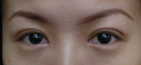 韩式三点双眼皮手术后效果