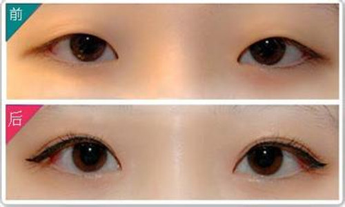 韩式三点双眼皮手术效果