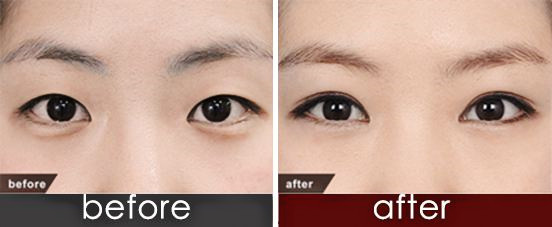 南京三点定位双眼皮,南京韩式三点定位双眼皮价格多少钱,韩式三点定位双眼皮手术，影响韩式三点定位双眼皮价格