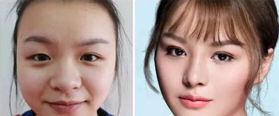 韩式割双眼皮的优势