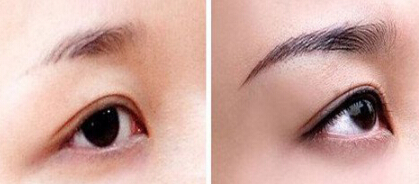 眉毛种植术可以改变哪些