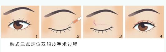 韩式三点定位双眼皮全过程图文介绍