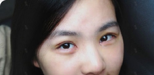 真实案例：韩式双眼皮手术恢复记录