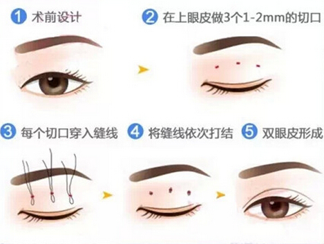 韩式双眼皮需要拆线吗？