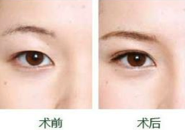 康小华科普：韩式双眼皮手术原理