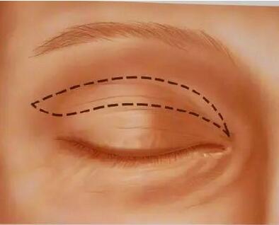 双眼皮手术过程