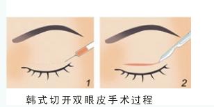韩式三点定位双眼皮全过程图文介绍
