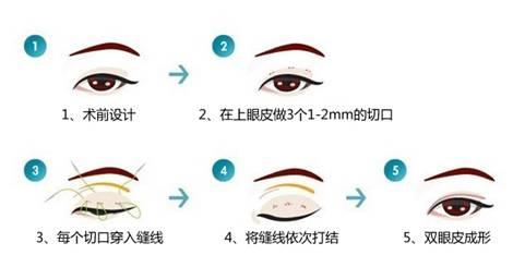 韩式双眼皮手术步骤