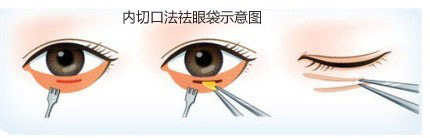 内切口法祛眼袋示意图