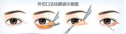 外切口法祛眼袋示意图