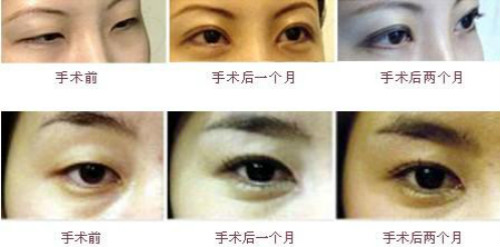 韩式双眼皮手术对比照片 赶紧围观！