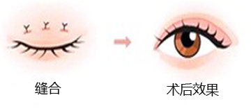 干货分享：韩式双眼皮手术有哪些？