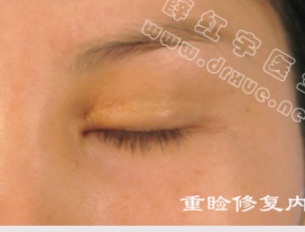 薛红宇双眼皮修复真实案例:内眦疤痕切除